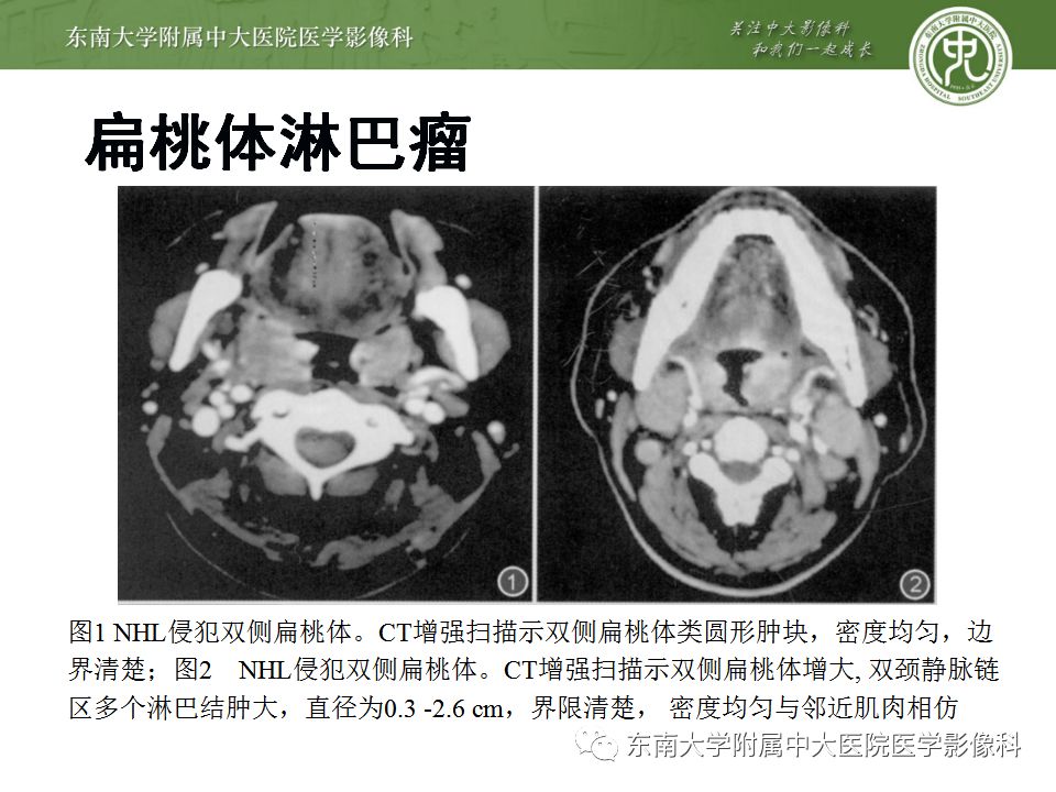 头颈部扁桃体癌影像学表现