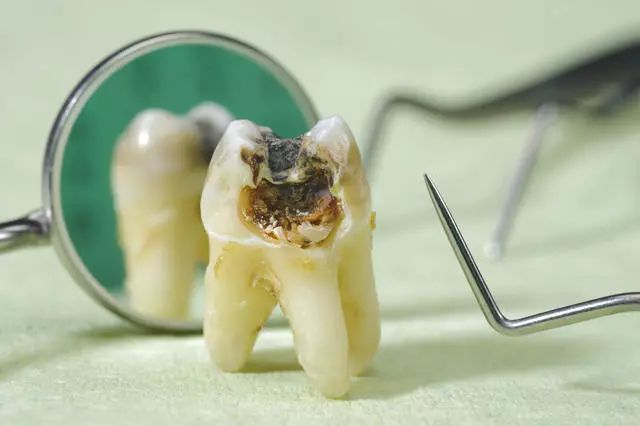 除了刷牙和含氟牙膏,预防龋齿的第三大法宝你知道吗?
