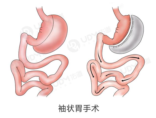 icu急救后决定做缩胃手术,250斤女生成功脱险