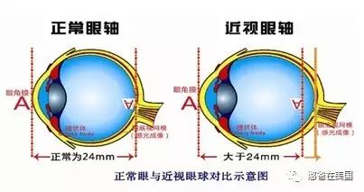 手术治疗近视眼的原理_MCT技术控制近视 非手术治疗近视的首选