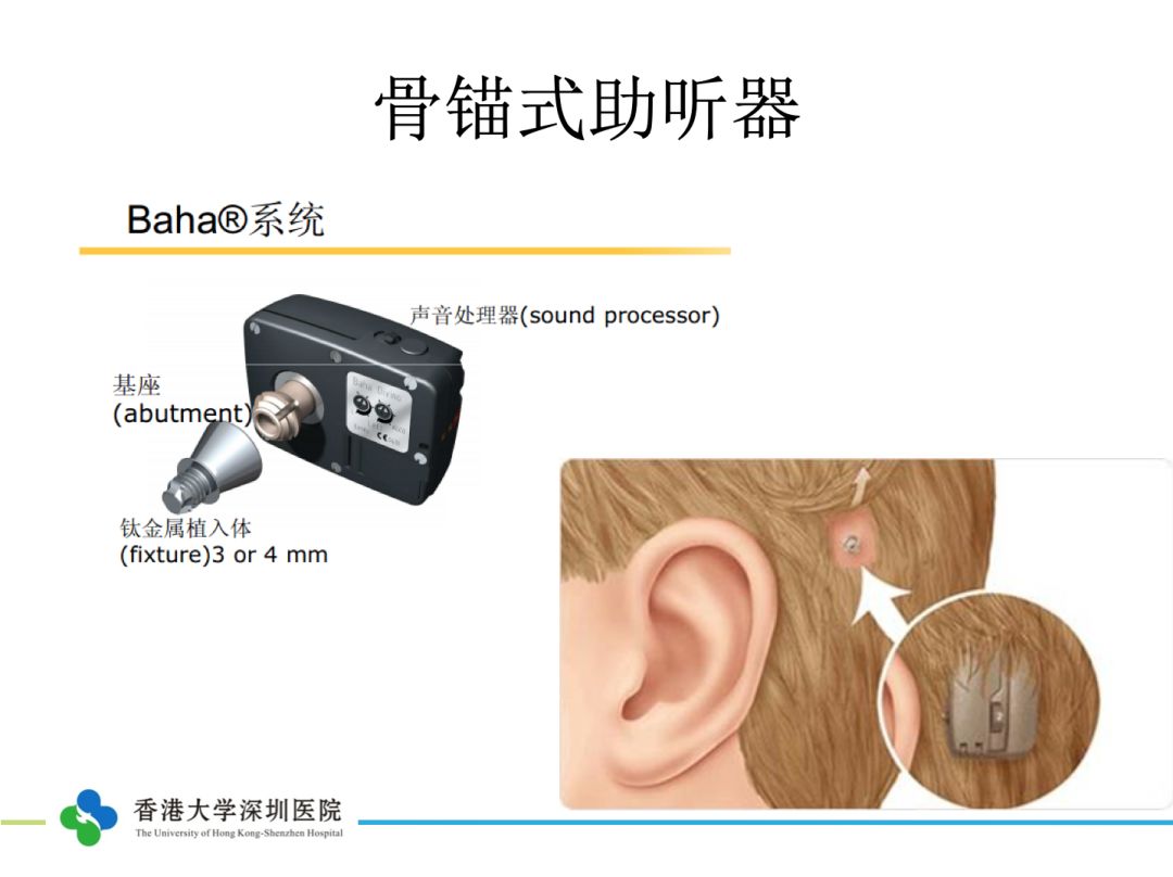 在骨头里面埋进一个助听器,这个助听器也是可以接收声波,通过骨导直接