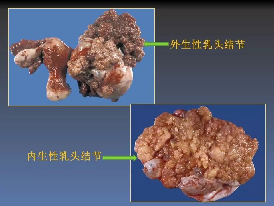 双侧卵巢交界性浆液性乳头状肿瘤