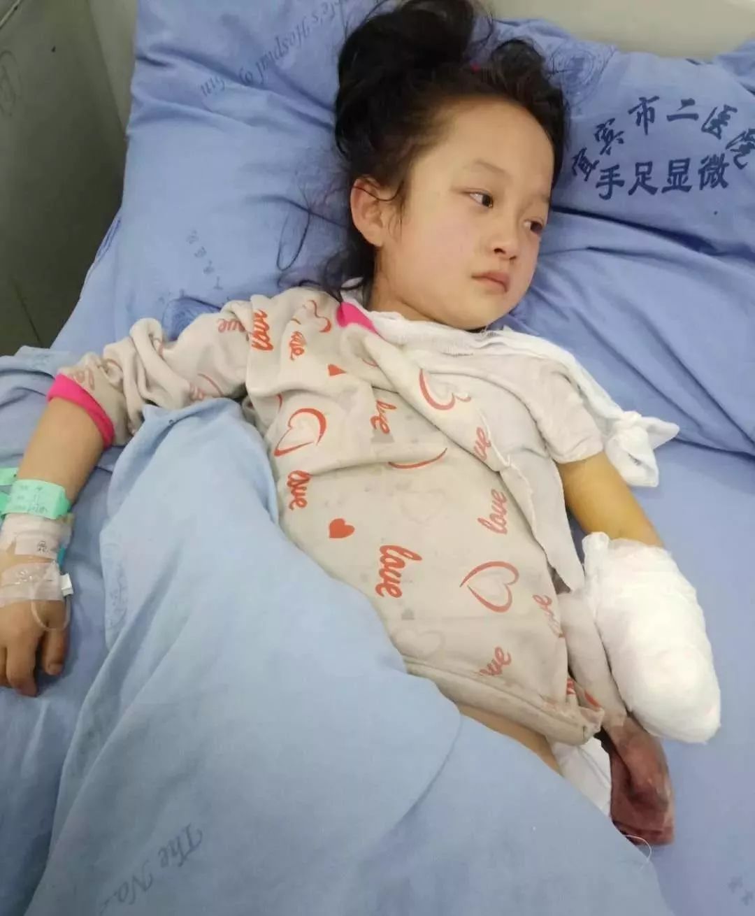 宜宾一8岁小女孩帮忙干活时被机器砍掉手掌,只能截肢.