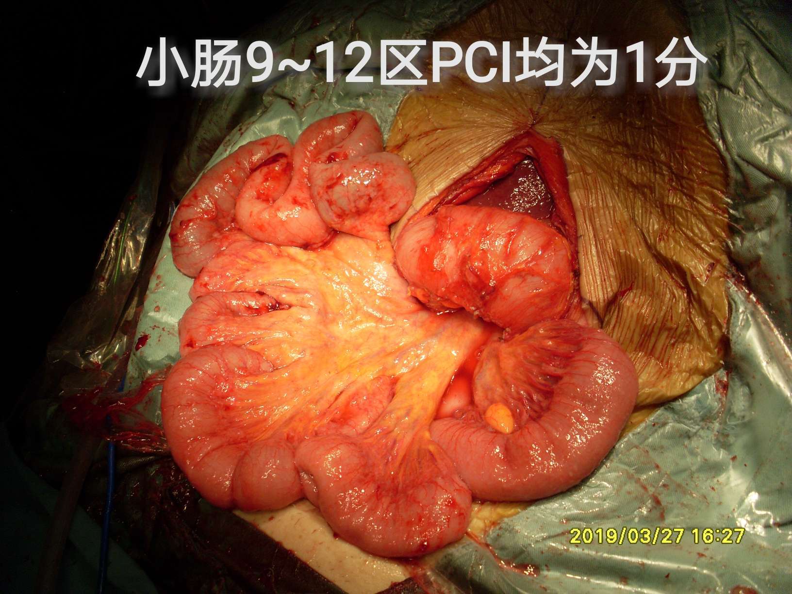 病例(33)--小小阑尾,大大卵巢 (原创)