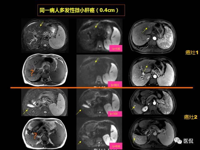 看看这例微小肝癌的mr诊断#医学影像ppt