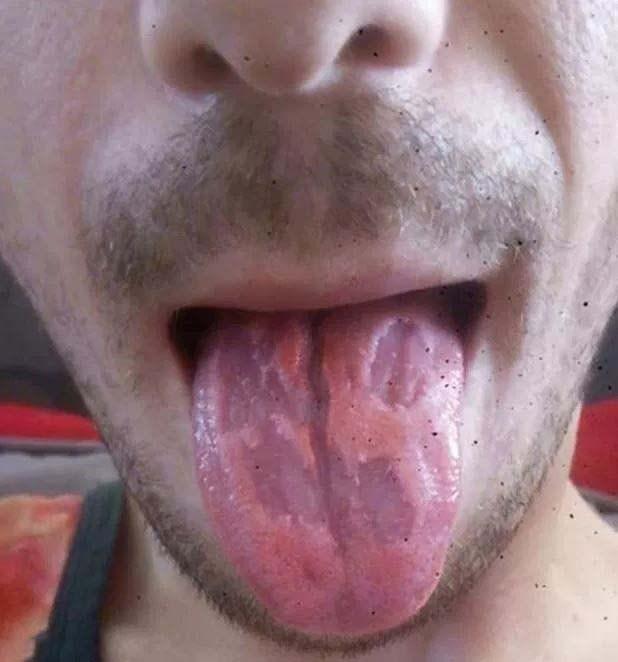 英国一名男子近日在脸书上分享一张舌头的照片,舌头上的舌苔坑坑洼洼