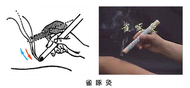 艾堂之悬灸常用手法