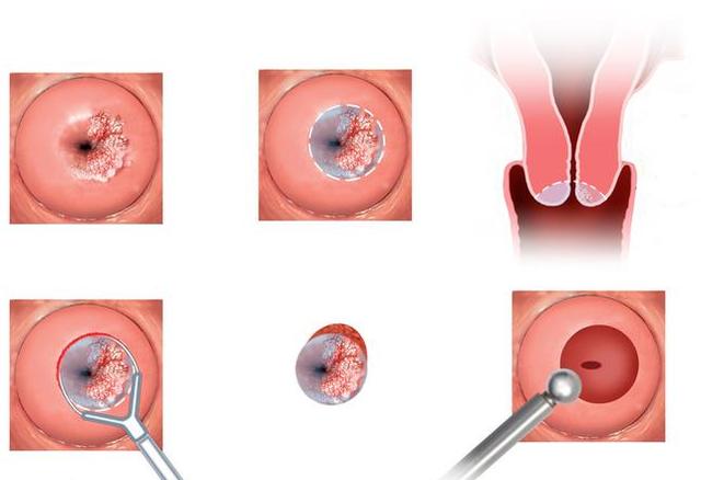 宫颈癌人口_宫颈癌早期症状图片
