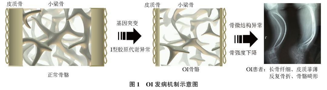 成骨不全症临床诊疗指南