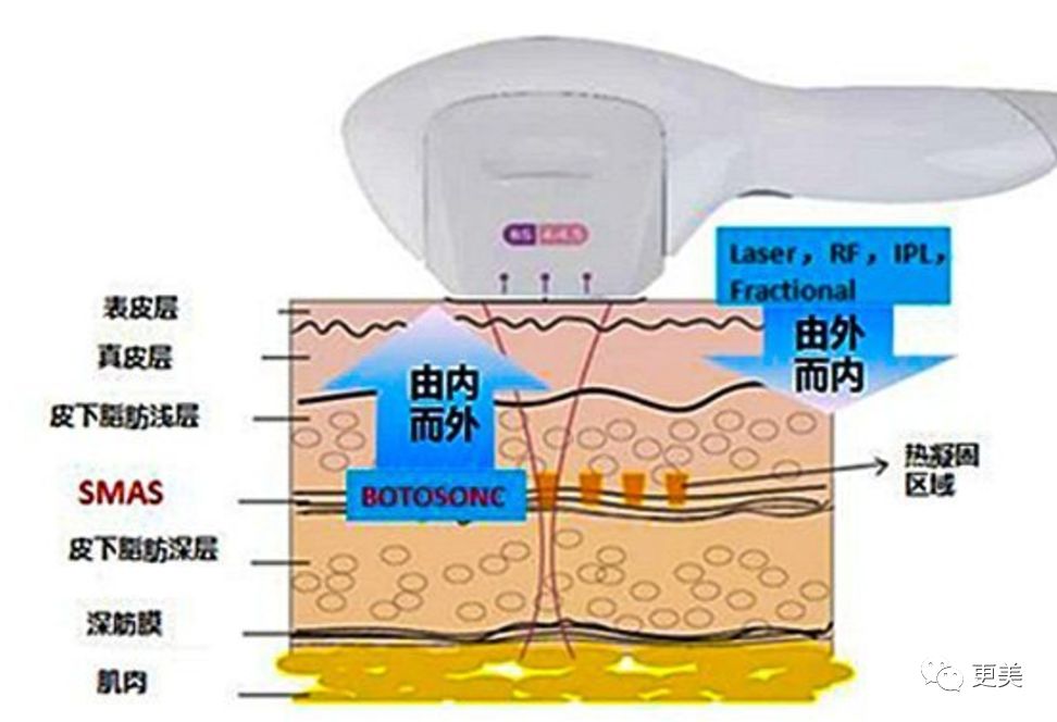 美容超声刀原理是什么_白带是什么图片(2)