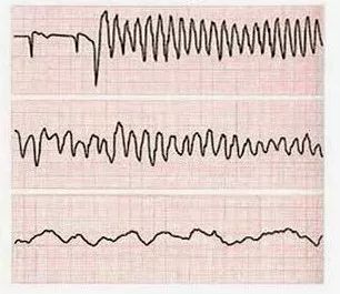 健康 正文  上:心室扑动;中:心室扑动-心室颤动;下:心室颤动 处理