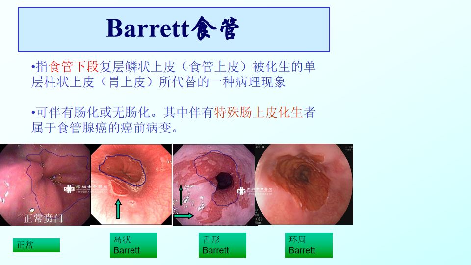 【科普】三分治疗七分养护,快来学学胃食管反流病如何