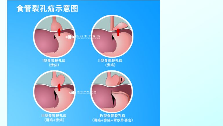 接着介绍了什么是食管裂孔疝和食管裂孔疝的分型.