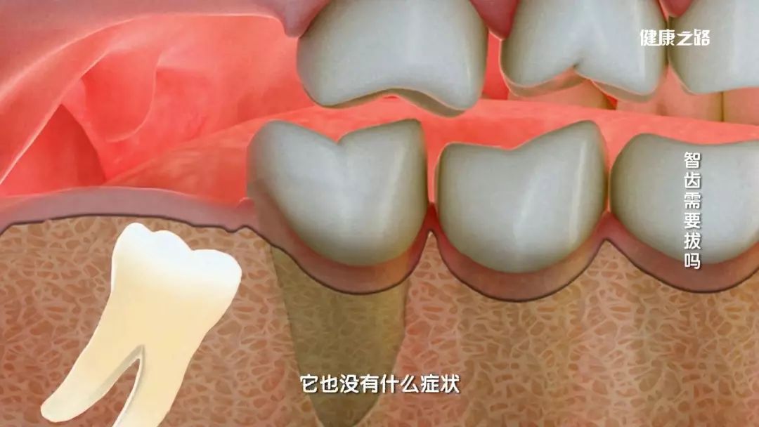 智齿不疼也可能要拔除?你在不在拔智齿的队伍中