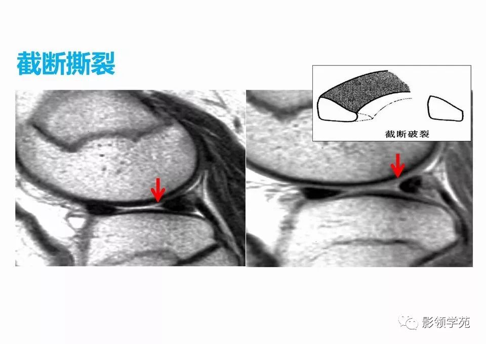 膝关节半月板损伤mr扫描与诊断