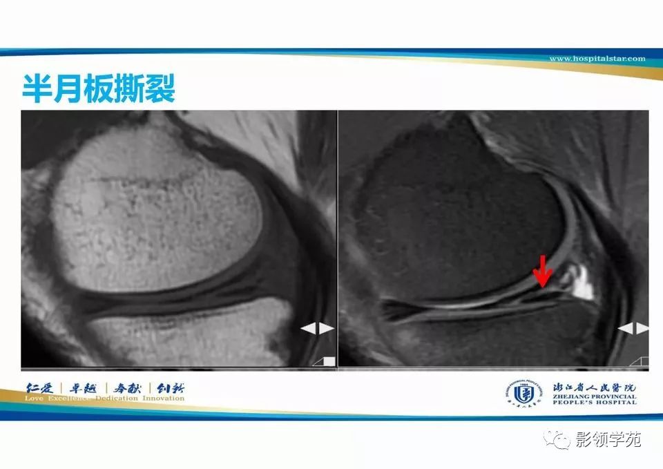 膝关节半月板损伤mr扫描与诊断