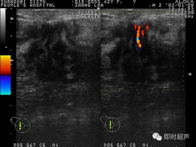 乳腺疾病的超声诊断有图有真相