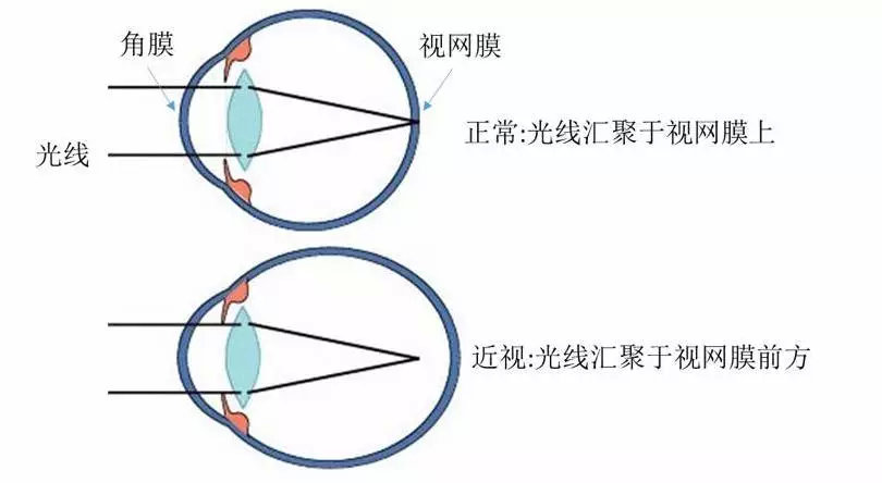 人为什么会近视的科学原理_为什么会近视图片