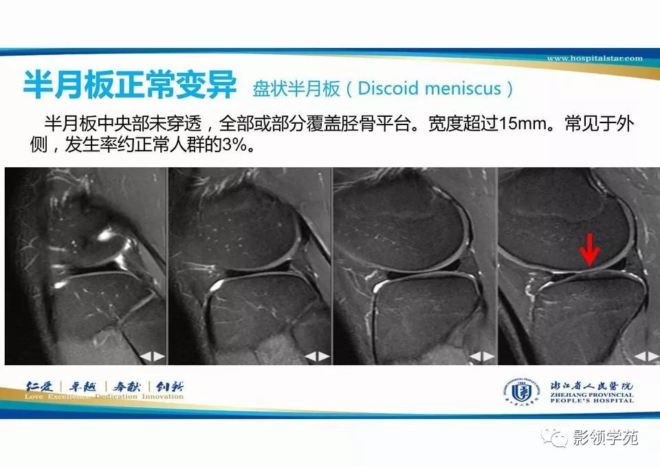 膝关节半月板损伤mr扫描与诊断