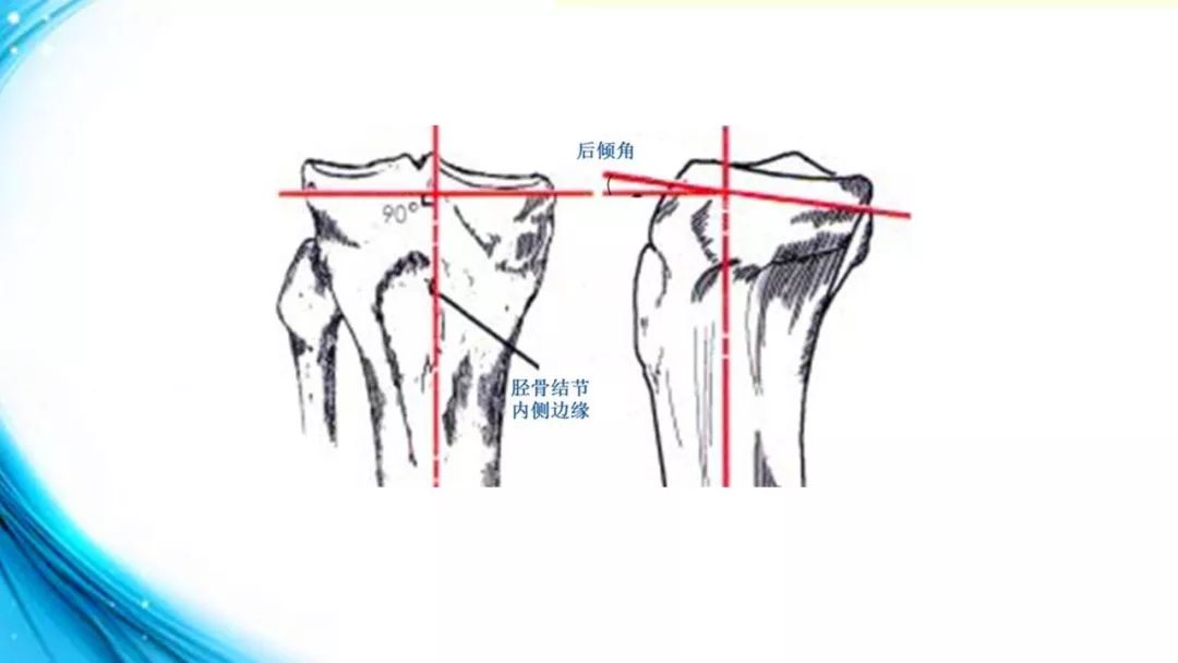 膝关节解剖与膝骨性关节炎的诊治