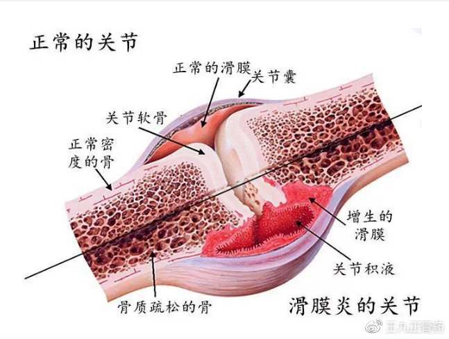 图02 正常滑膜与滑膜炎的滑膜对比