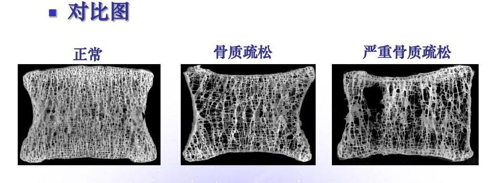 骨质疏松为什么目前骨质疏松是老年椎体压缩骨折中最主要原因.随