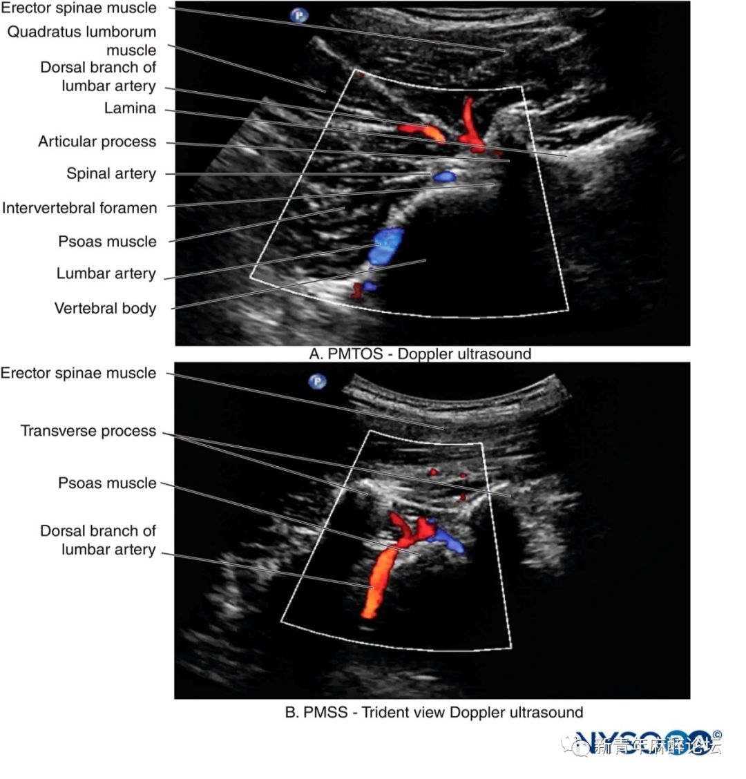 超声解剖•腹壁下动脉与腹股沟管内环|腹壁|探头|腹股沟|位置|动脉|-健康界