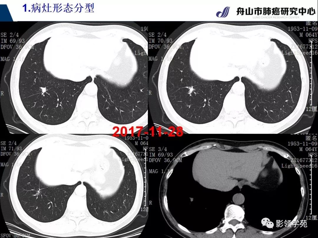 【经典课堂】早期周围型肺鳞癌ct诊断及鉴别诊断(上)