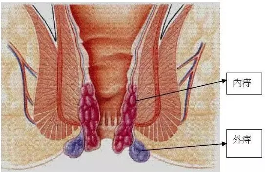 痔疮垫什么原理_轻微的痔疮长什么样子
