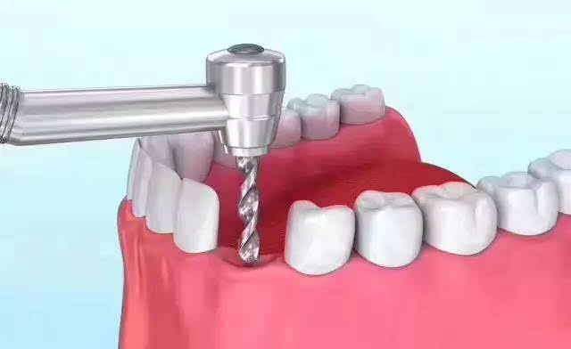 柏德口腔分析种植牙的优势有哪些