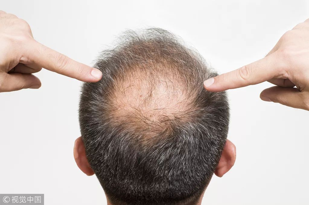 你离脱发还有多远出现这几种预兆你可能要秃头了