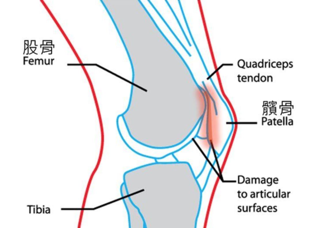 3 鹅足肌腱炎症状:突出于膝盖内侧的肌腱疼痛,尤其常见于左腿.