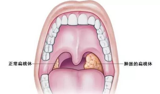 哪些情况需要摘除扁桃体