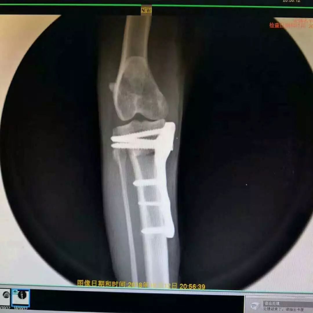 【足根関節側副靭帯損傷】 今回の症例は、紹介症例です。10日ほど前に交通事故で跛行をしていた猫ちゃんですが、踵の関節の側副靭帯の付着部の骨が ...