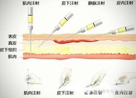 本注射方法的所用药物为肾上腺素和阿托品等.4,皮内注射本注射方法