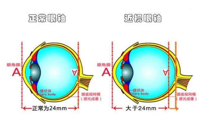 近视人口_中国近视人口比例图