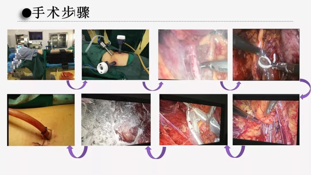 【护理查房】后腹腔镜下输尿管切开取石术