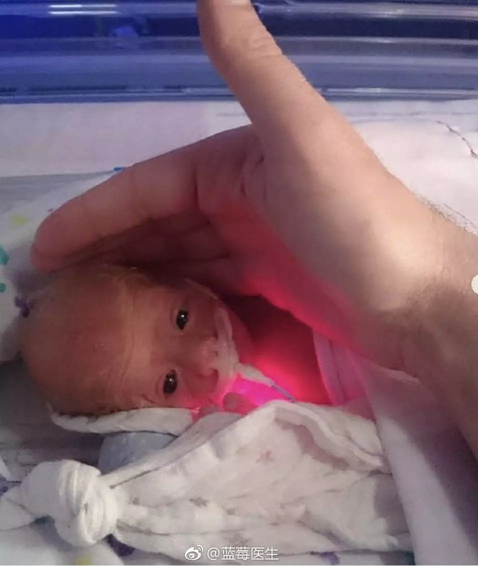 "袋鼠包"拯救28周早产宝宝:比保温箱还靠谱的护理你一定要知道!