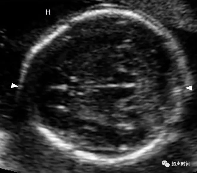 产前超声:胎儿颅面部畸形