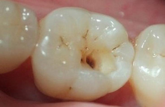 中龋——感染牙本质表层:到这个阶段,已经能看到明显的蛀洞,此时的