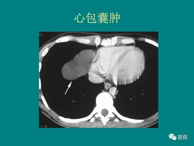 纵膈解剖和常见病#医学影像经典ppt