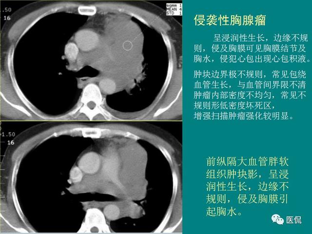 纵膈解剖和常见病#医学影像经典ppt