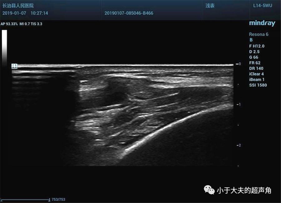 超声误入歧途的肌肉肌疝