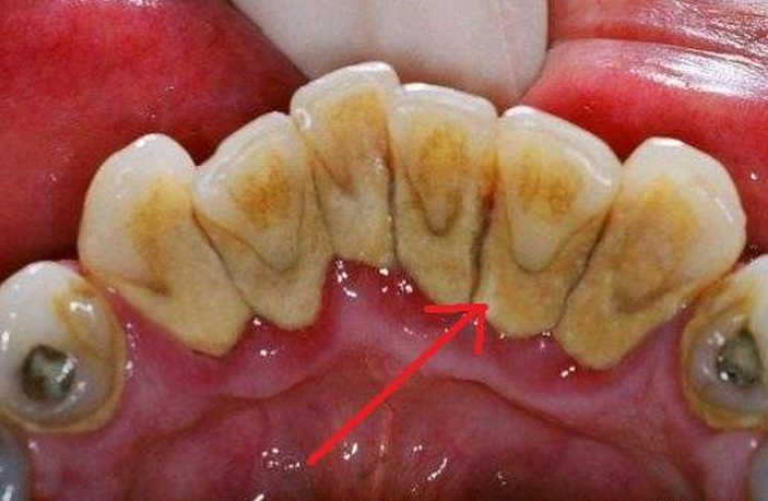 牙科医生牙缝里的牙垢又臭又硬教你一个小妙招脏牙垢自动掉落