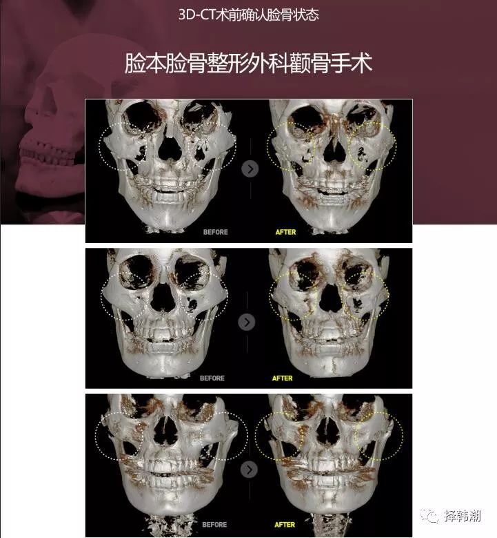 颧骨整形为何选择脸本脸骨facebone整形医院呢