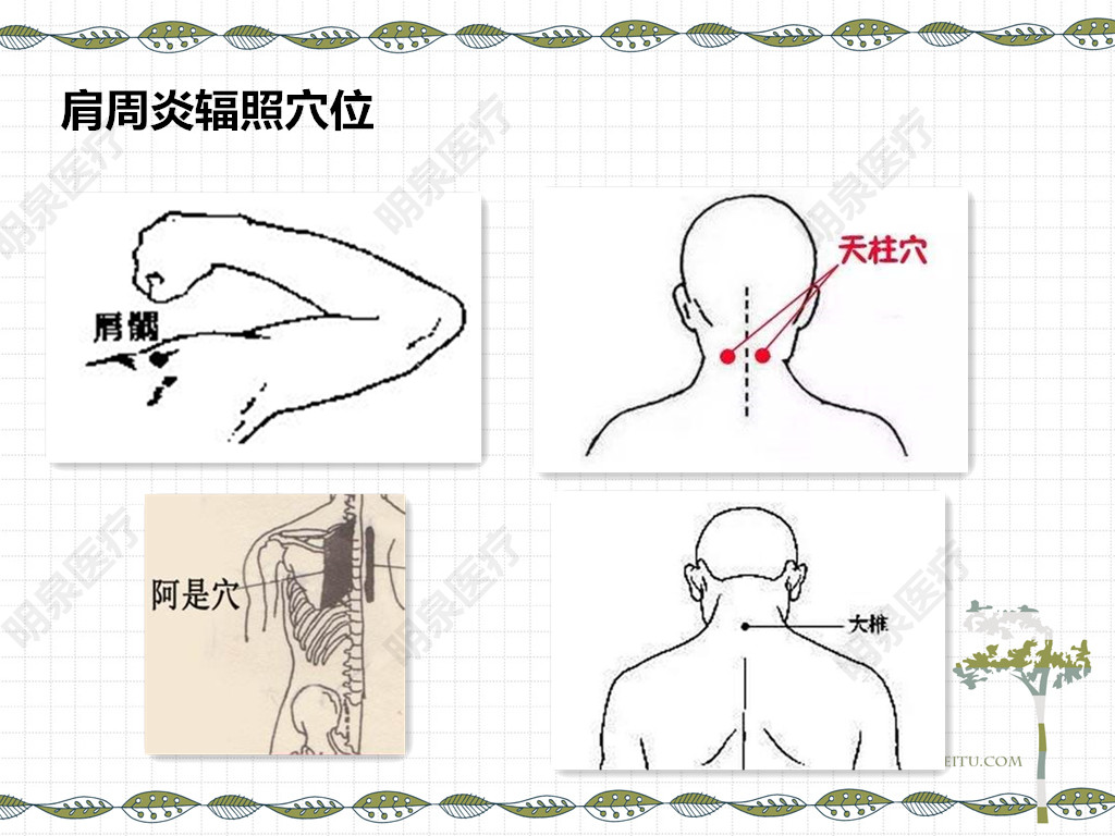 在治疗肩周炎时应辐照肩髃穴(患侧),阿是穴,大椎穴,天柱穴(双) 穴位