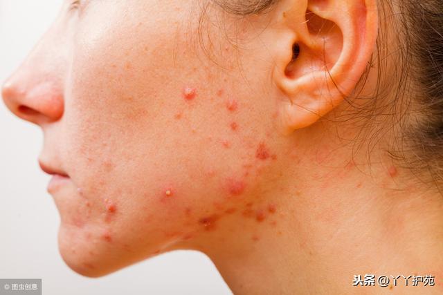 中医认为左脸颊长痘是由于肝功能不顺畅,有热毒;右脸颊长痘是由于肺