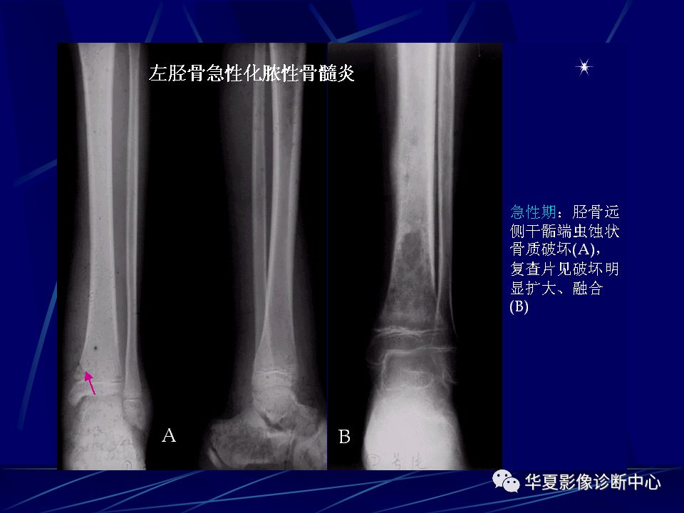 骨化脓性骨髓炎的影像学诊断