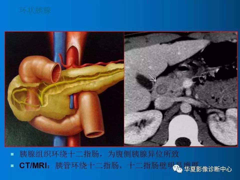 胰腺解剖及变异的影像表现