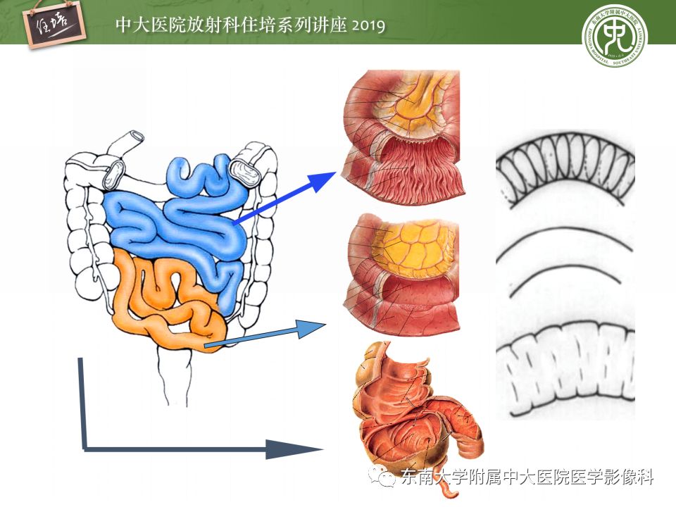 小肠梗阻的影像分析与诊断